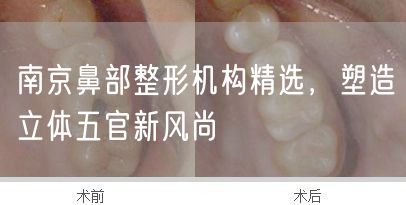 南京鼻部整形机构精选，塑造立体五官新风尚