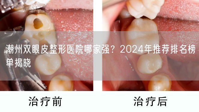 潮州双眼皮整形医院哪家强？2024年推荐排名榜单揭晓