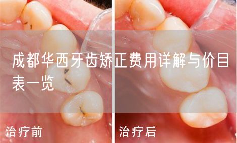 成都华西牙齿矫正费用详解与价目表一览