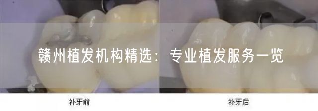 赣州植发机构精选：专业植发服务一览