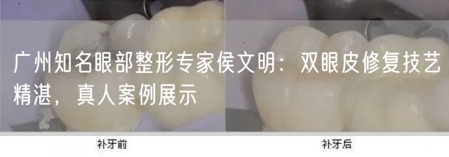 广州知名眼部整形专家侯文明：双眼皮修复技艺精湛，真人案例展示