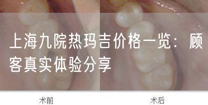 上海九院热玛吉价格一览：顾客真实体验分享