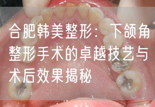 合肥韩美整形：下颌角整形手术的卓越技艺与术后效果揭秘