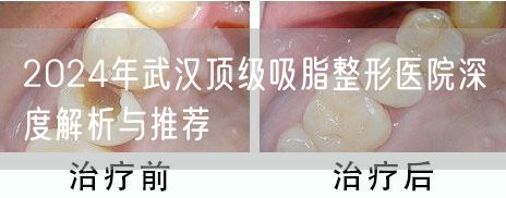 2024年武汉顶级吸脂整形医院深度解析与推荐