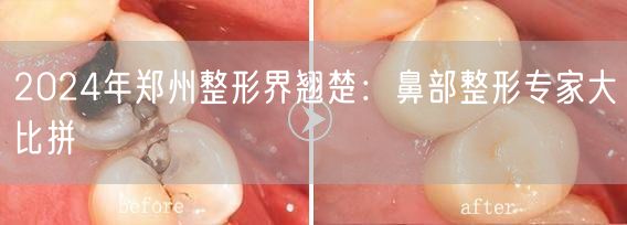 2024年郑州整形界翘楚：鼻部整形专家大比拼
