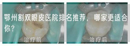 鄂州割双眼皮医院排名推荐，哪家更适合你？