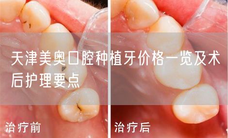 天津美奥口腔种植牙价格一览及术后护理要点