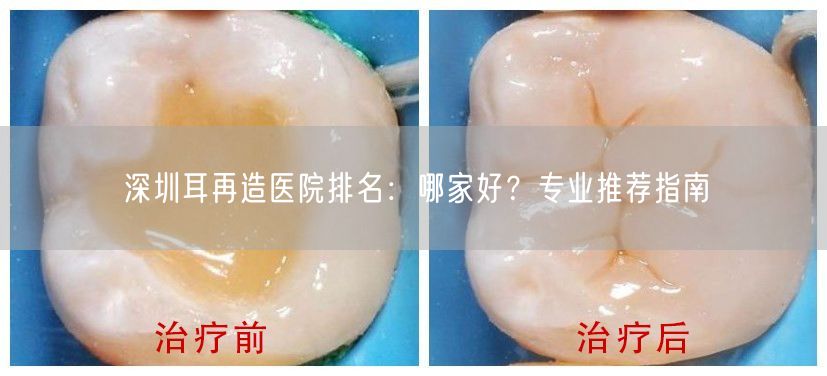 深圳耳再造医院排名：哪家好？专业推荐指南