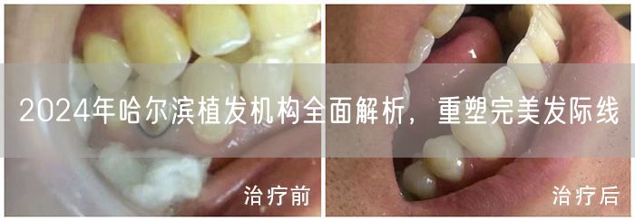 2024年哈尔滨植发机构全面解析，重塑完美发际线