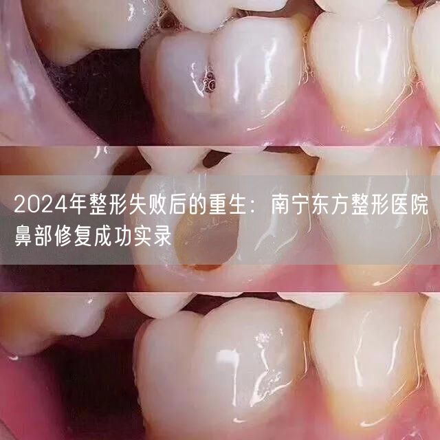 2024年整形失败后的重生：南宁东方整形医院鼻部修复成功实录