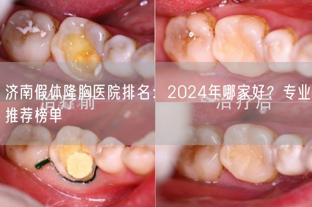 济南假体隆胸医院排名：2024年哪家好？专业推荐榜单