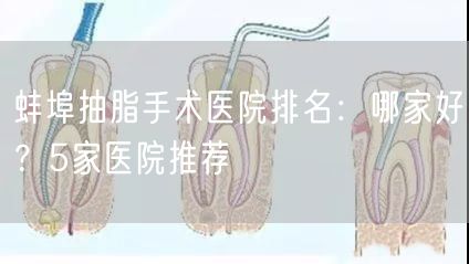 蚌埠抽脂手术医院排名：哪家好？5家医院推荐