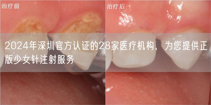 2024年深圳官方认证的28家医疗机构，为您提供正版少女针注射服务