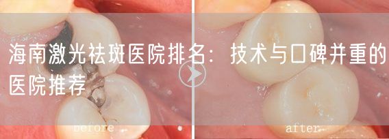 海南激光祛斑医院排名：技术与口碑并重的医院推荐