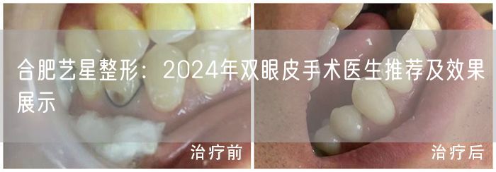 合肥艺星整形：2024年双眼皮手术医生推荐及效果展示