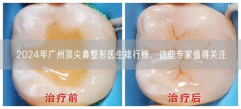 2024年广州顶尖鼻整形医生排行榜，这些专家值得关注