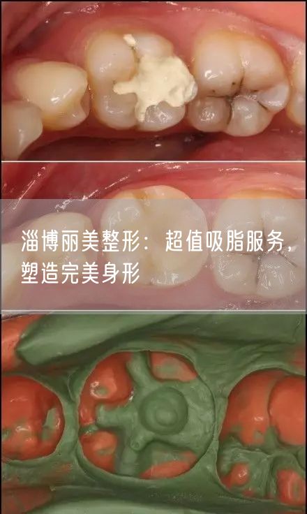 淄博丽美整形：超值吸脂服务，塑造完美身形