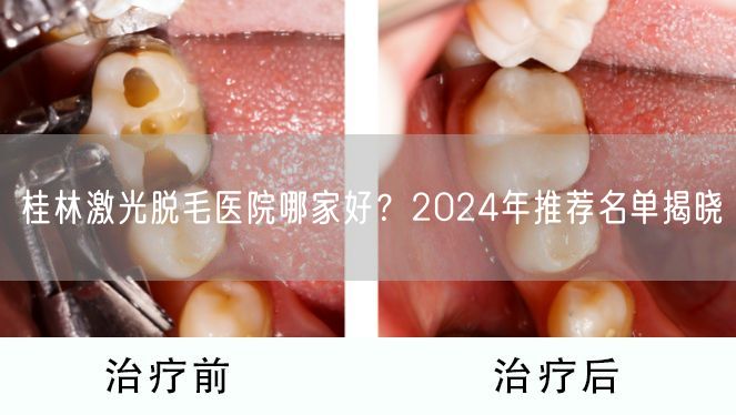 桂林激光脱毛医院哪家好？2024年推荐名单揭晓
