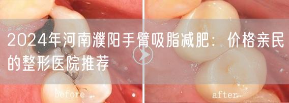 2024年河南濮阳手臂吸脂减肥：价格亲民的整形医院推荐