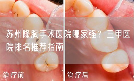 苏州隆胸手术医院哪家强？三甲医院排名推荐指南
