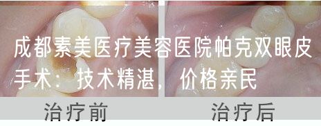 成都素美医疗美容医院帕克双眼皮手术：技术精湛，价格亲民