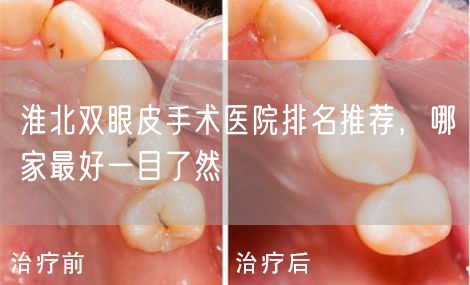 淮北双眼皮手术医院排名推荐，哪家最好一目了然