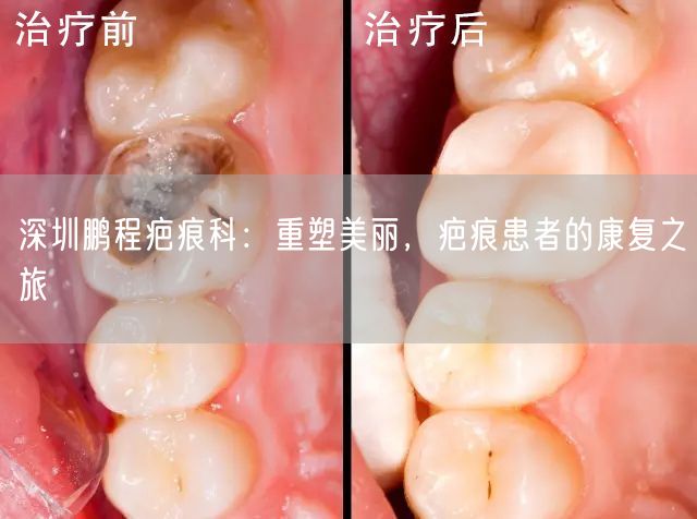 深圳鹏程疤痕科：重塑美丽，疤痕患者的康复之旅