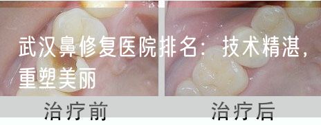 武汉鼻修复医院排名：技术精湛，重塑美丽