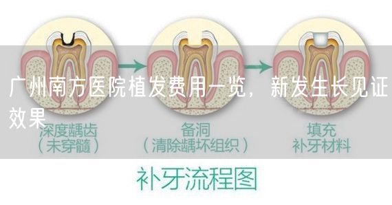 广州南方医院植发费用一览，新发生长见证效果