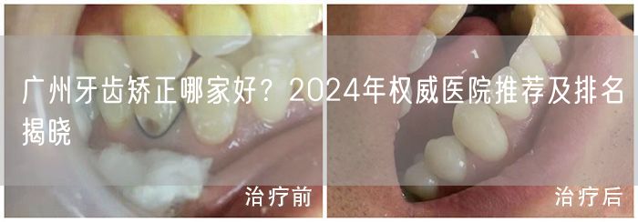 广州牙齿矫正哪家好？2024年权威医院推荐及排名揭晓