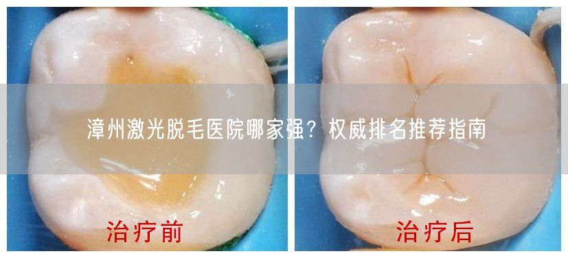 漳州激光脱毛医院哪家强？权威排名推荐指南