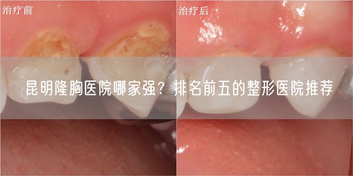 昆明隆胸医院哪家强？排名前五的整形医院推荐