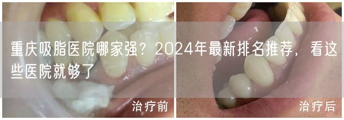 重庆吸脂医院哪家强？2024年最新排名推荐，看这些医院就够了