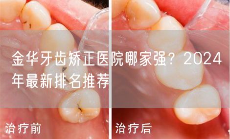 金华牙齿矫正医院哪家强？2024年最新排名推荐