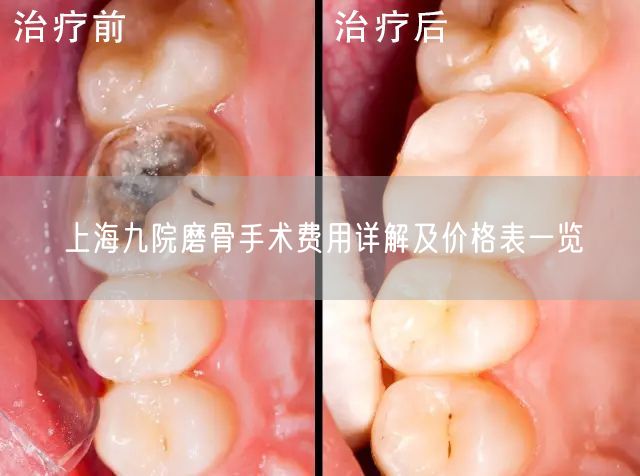 上海九院磨骨手术费用详解及价格表一览