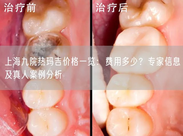 上海九院热玛吉价格一览：费用多少？专家信息及真人案例分析