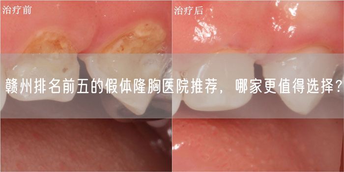 赣州排名前五的假体隆胸医院推荐，哪家更值得选择？