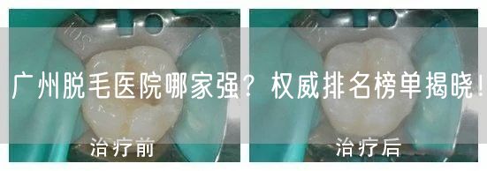 广州脱毛医院哪家强？权威排名榜单揭晓！