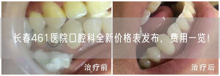长春461医院口腔科全新价格表发布，费用一览！