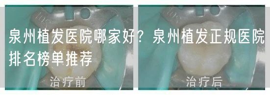 泉州植发医院哪家好？泉州植发正规医院排名榜单推荐