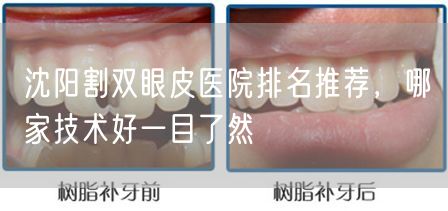 沈阳割双眼皮医院排名推荐，哪家技术好一目了然