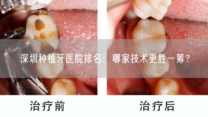 深圳种植牙医院排名：哪家技术更胜一筹？