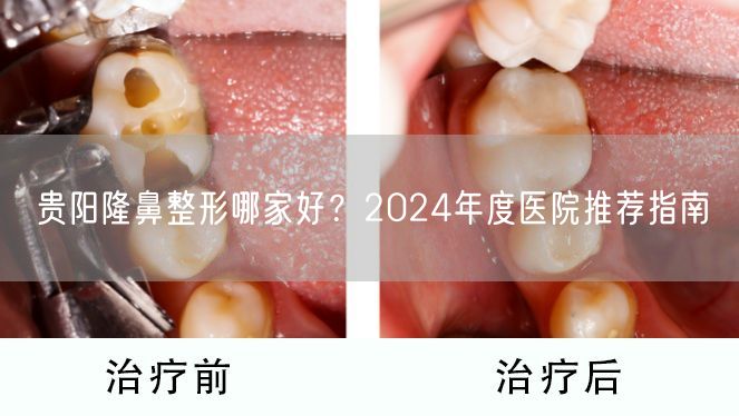 贵阳隆鼻整形哪家好？2024年度医院推荐指南