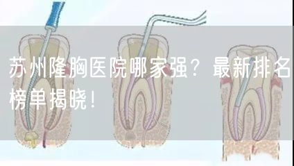 苏州隆胸医院哪家强？最新排名榜单揭晓！
