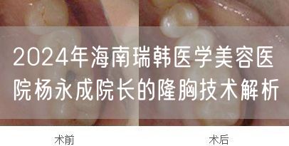 2024年海南瑞韩医学美容医院杨永成院长的隆胸技术解析