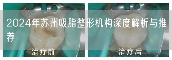 2024年苏州吸脂整形机构深度解析与推荐