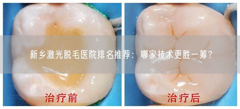 新乡激光脱毛医院排名推荐：哪家技术更胜一筹？