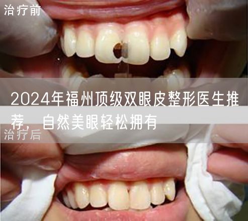 2024年福州顶级双眼皮整形医生推荐，自然美眼轻松拥有