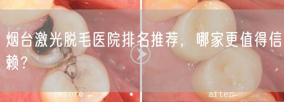 烟台激光脱毛医院排名推荐，哪家更值得信赖？