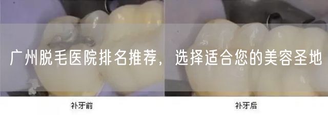 广州脱毛医院排名推荐，选择适合您的美容圣地
